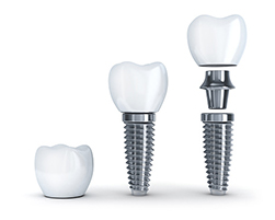 a 3D rendering of a dental implant