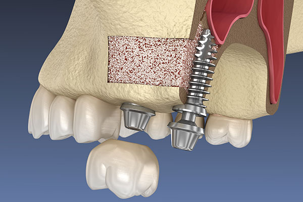  Close up 3D rendering of a dental implant with bone graft Mountain State Oral and Facial Surgery in Charleston, WV