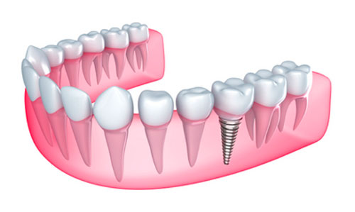 Dental implants being placed at Mountain State Oral and Facial Surgery in Charleston, WV