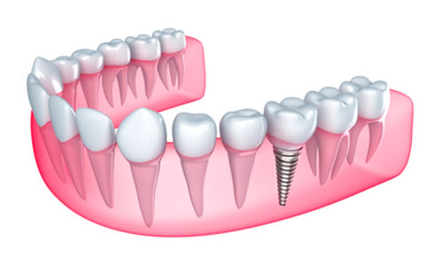 What Can You Eat After Dental Implant Surgery