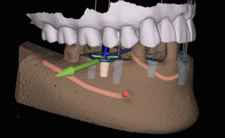 Digital 3D model of a jaw with dental implants, rendered by the X-guide system