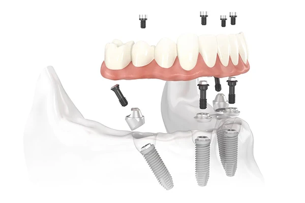 Diagram of all on 4 dental implants by Mountain State Oral and Facial Surgery in Kanawha City, WV