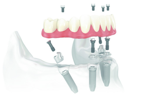 Are All on 4 Implants Easier to Get Than Full Dental Implants?