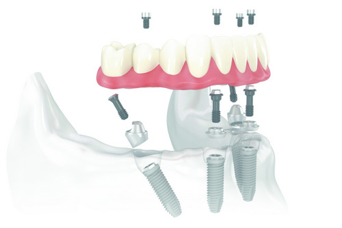 Diagram of All-on-4 Treatment Concept from Mountain State Oral and Facial Surgery in Charleston, WV