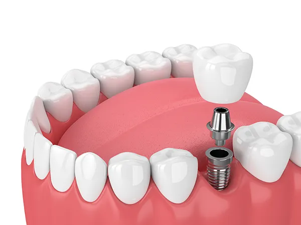 3D rendering of a dental implant and its components being placed into the jaw at Mountain State Oral and Facial Surgery in Charleston, WV