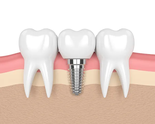 3D rendered cross-section view of a dental implant placed in the jaw between two healthy teeth at Mountain State Oral and Facial Surgery in Beckley, WV