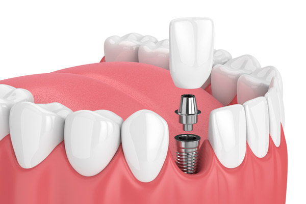 A 3D rendering of a dental implant and post