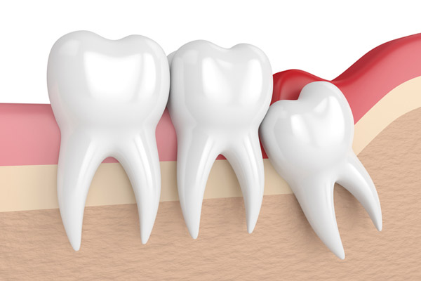 Illustration of an impacted wisdom tooth from Mountain State Oral and Facial Surgery in Vinton, VA