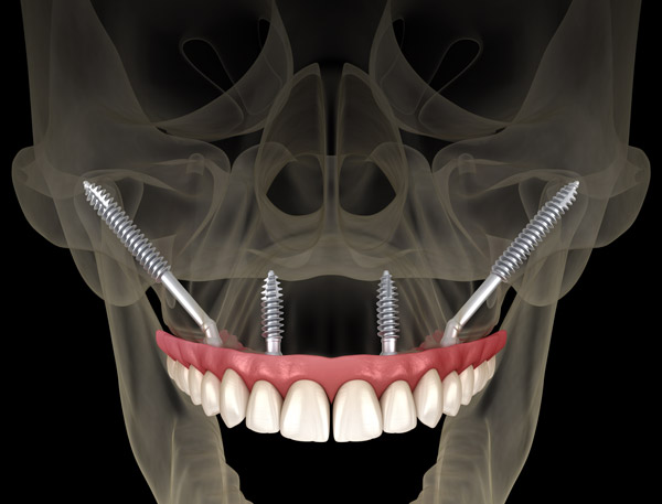 A 3D rendering of zygomatic dental implant placement at Mountain State Oral and Facial Surgery in Charleston, WV