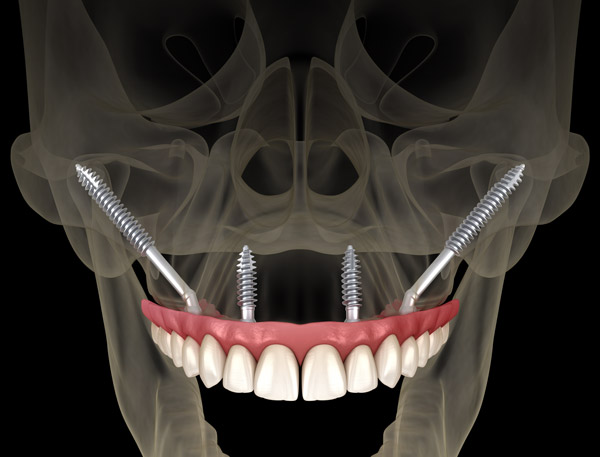 Diagram illustration of zygomatic implants in the jaw at Mountain State Oral and Facial Surgery in Hurricane, WV