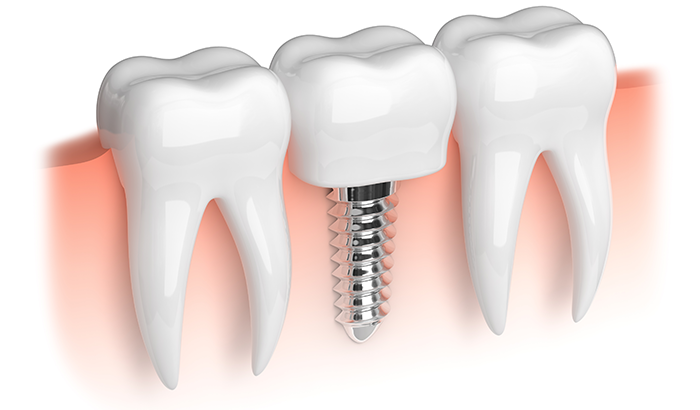 a dental implant image in Charleston, WV