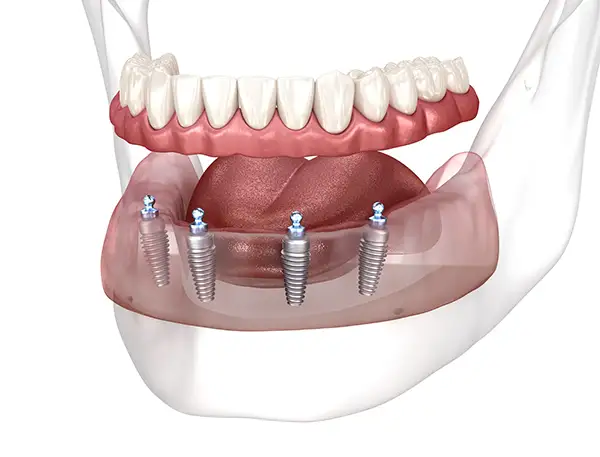 Lower jaw All-on-4 dental implants being installed to support a full set of artificial teeth.