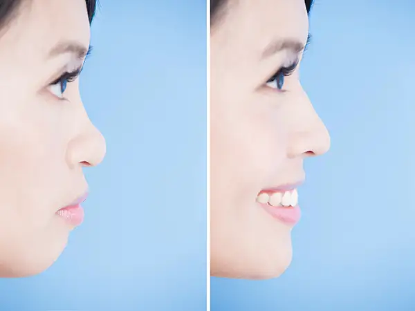 Side-by-side profile comparison of a woman before and after cosmetic dental treatment, highlighting improved smile and facial profile.