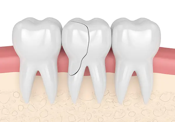 Cross-section of a cracked tooth in the gumline, highlighting the fracture along the enamel and root.