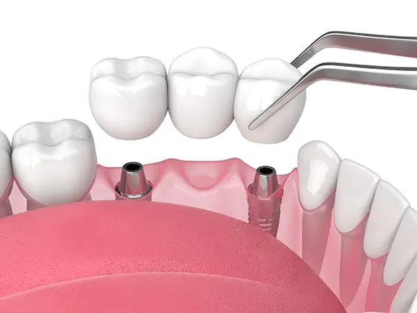 Close-up of a dental implant bridge being placed with tweezers onto two implant abutments in the jaw.