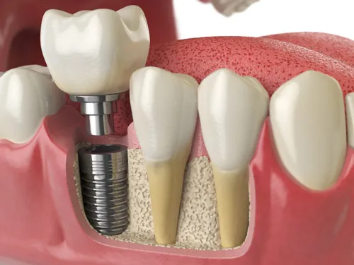 a 3d rendering of a dental implant cross section