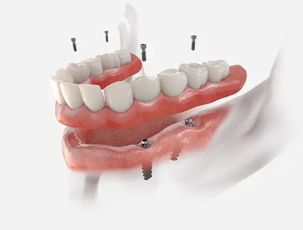 Upper and lower implant-supported dentures being attached to titanium implants for full dental restoration.