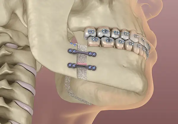 Orthognathic surgery illustration showing the process of jaw correction with plates and screws.