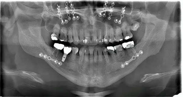 X-ray of a jaw after orthognathic surgery, showing plates, screws, and dental alignment improvements.