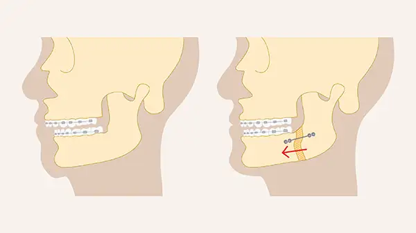 Illustration comparing side profiles of a patient before and after orthognathic surgery, highlighting lower jaw correction.