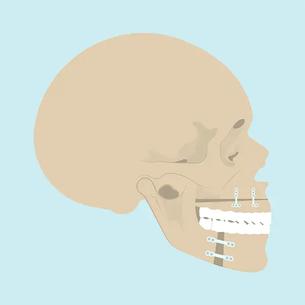 Diagram showing the side view of a skull with orthognathic surgery plates and screws, detailing surgical alignment.