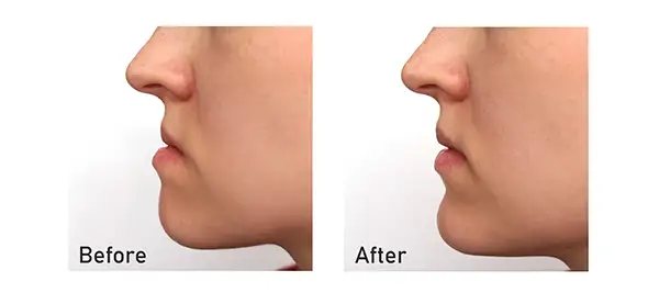 Before and after profile photos of a patient who underwent orthognathic surgery, showing significant jaw alignment improvements.