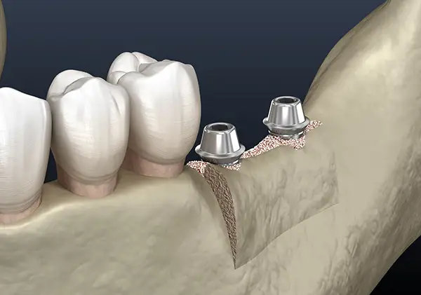 A dental ridge augmentation procedure showing bone graft material placed to support two dental implants in the lower jaw.