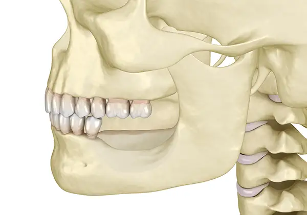 Skull with restored jawbone structure after a ridge augmentation procedure that fixes bone recession after losing molar teeth.