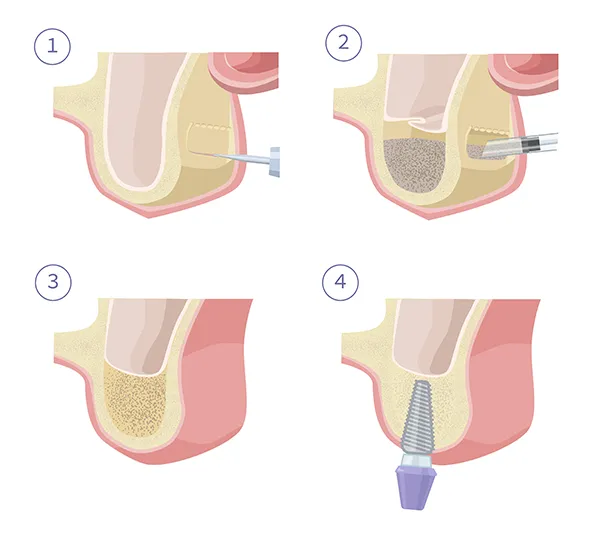 A four-step diagram demonstrating how a sinus lift reinforces the upper jaw to support the later installation of a dental implant.