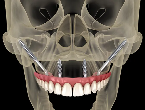X-ray view of how zygomatic implants make use of the depth available within the cheekbones to enhance the security and permanence of full arch teeth restorations.